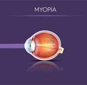 Myopia Eye Diagram
