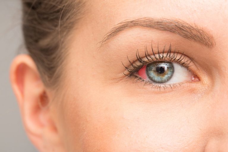 red spot on eye after lasik